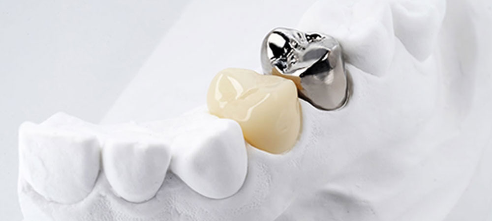 保険適用の白い歯（CAD/CAM冠）